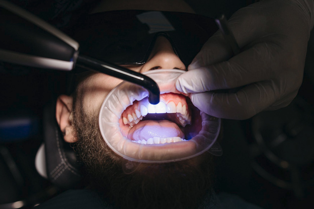 Can I Get Teeth Whitening After Dental Implants | Rosenberg Can I Get Teeth Whitening After Dental Implants | Rosenberg