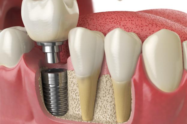 Dental Implants in Richmond restoring smiles with permanent tooth replacement, natural look, and improved chewing