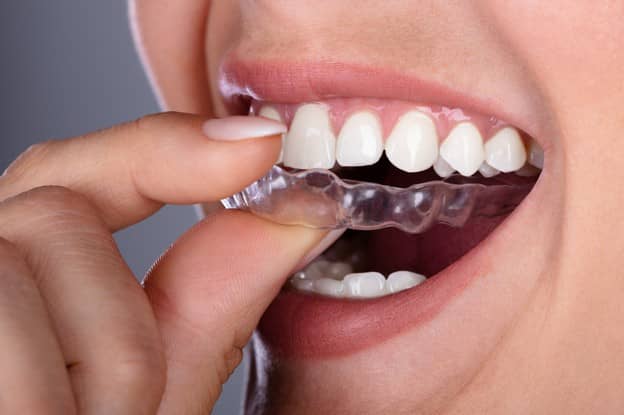 Enjoying The Smile Improvements Offered By MTM Aligners Enjoying The Smile Improvements Offered By MTM Aligners