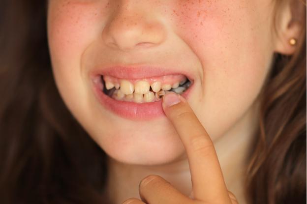 Child pointing to a tooth with visible decay, highlighting why visiting a pediatric dentist in Katy is important for early cavity prevention