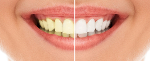 Is It Possible to Whiten Teeth With Veneers? | Richmond Is It Possible to Whiten Teeth With Veneers? | Richmond