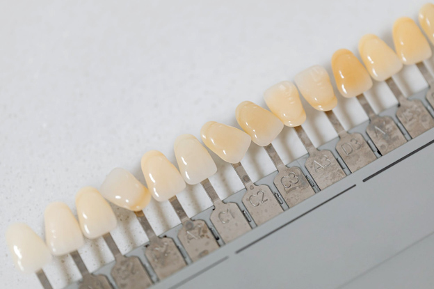 Placement Process of Porcelain Veneers | Richmond | Katy Placement Process of Porcelain Veneers | Richmond | Katy