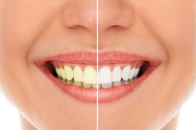 Professional Teeth Whitening to Whiten Your Teeth | Richmond Professional Teeth Whitening to Whiten Your Teeth | Richmond