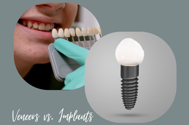 Veneers vs. Implants: What's the Best Option? Veneers vs. Implants: What's the Best Option?
