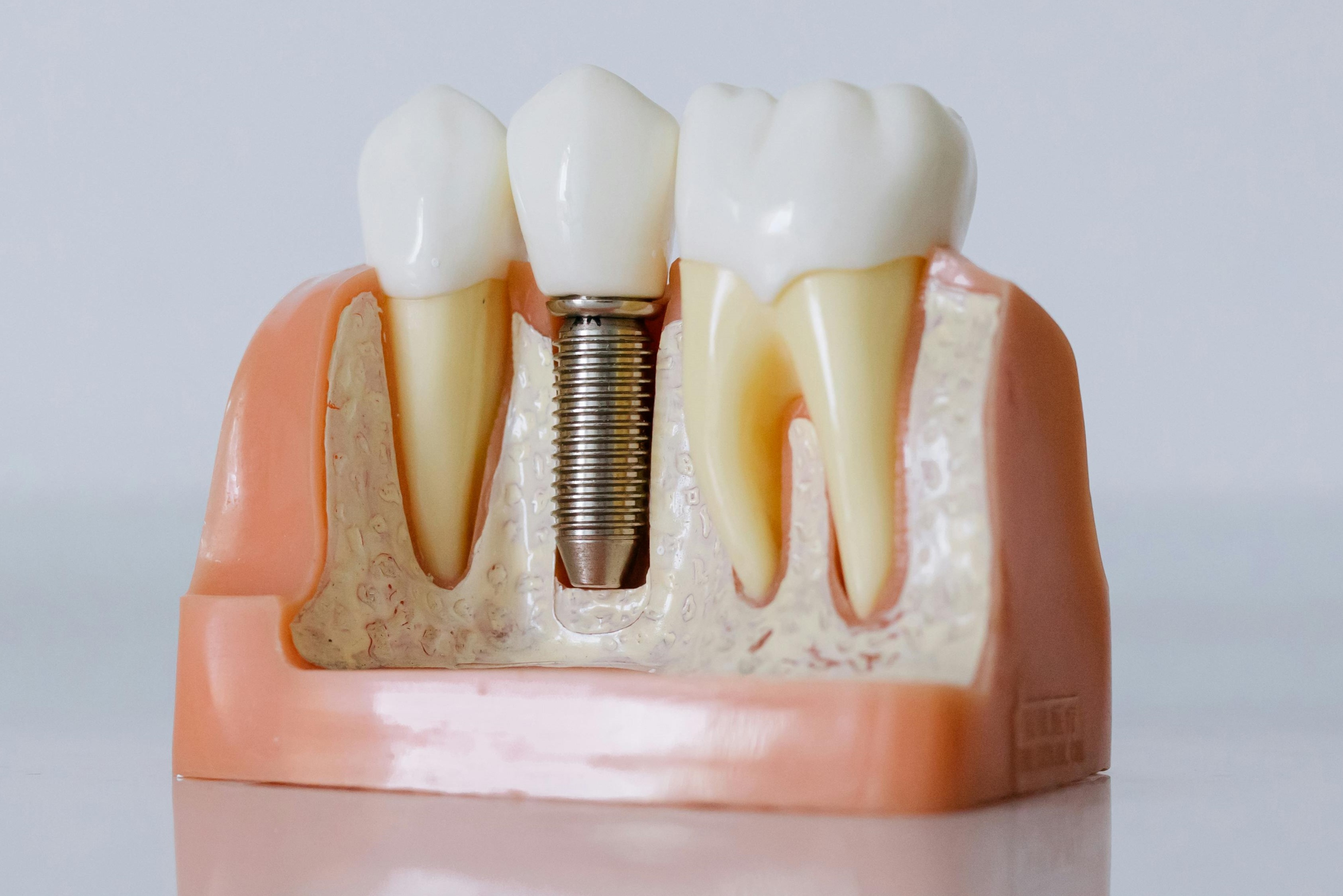 What to Expect When Getting Dental Implants in Richmond What to Expect When Getting Dental Implants in Richmond