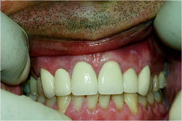 Dental Crowns After