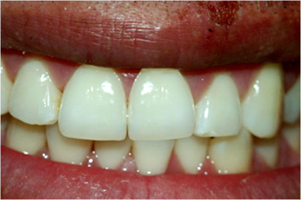 Dental Crowns After